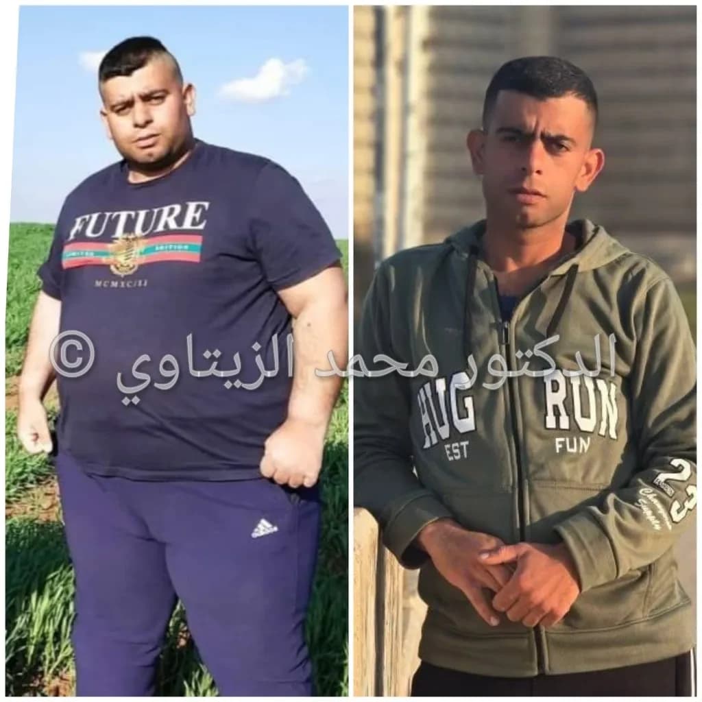 نتيجة تكميم المعدة: نزول 91 كيلو خلال 10 شهور | د. محمد عبد الوهاب الزيتاوي صورة قبل وبعد عملية تكميم المعدة للمريض محمود مياس من الأردن: نزول من 180 إلى 89 كيلو خلال 10 شهور — مركز الدكتور محمد عبد الوهاب الزيتاوي