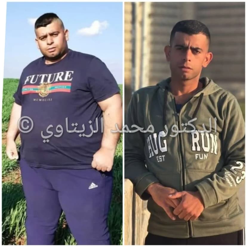 نتيجة تكميم المعدة: نزول 91 كيلو خلال 10 شهور | د. محمد عبد الوهاب الزيتاوي صورة قبل وبعد عملية تكميم المعدة للمريض محمود مياس من الأردن: نزول من 180 إلى 89 كيلو خلال 10 شهور — مركز الدكتور محمد عبد الوهاب الزيتاوي