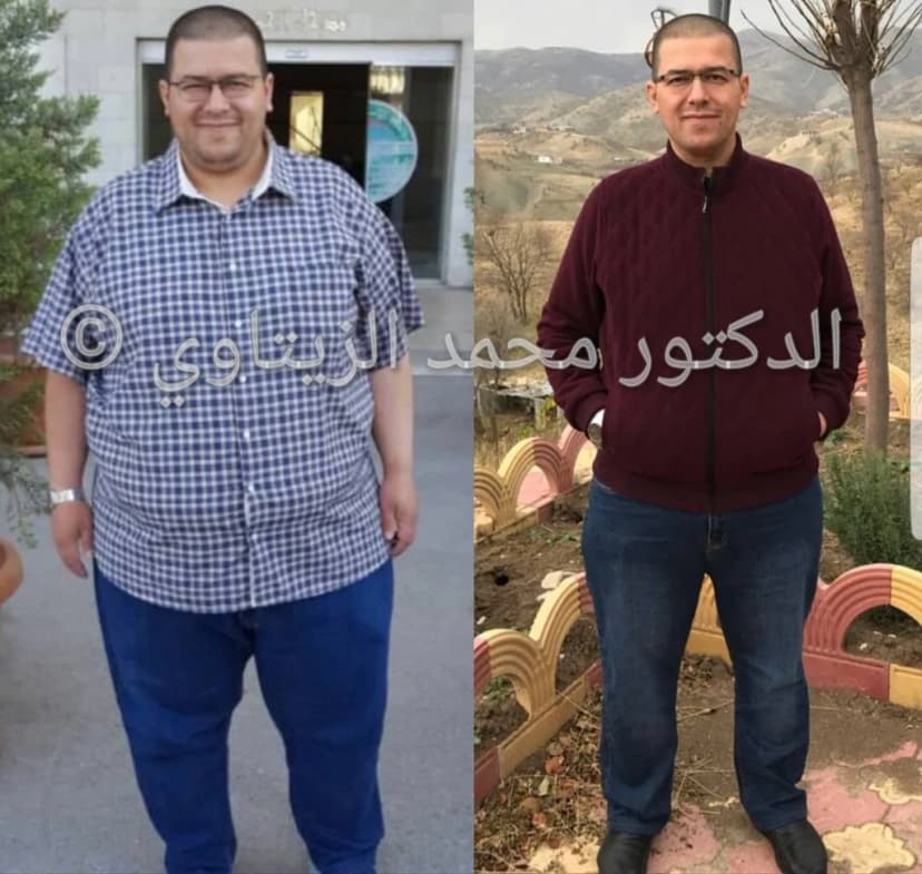 نتيجة تكميم المعدة: نزول 94.5 كيلو بعد سنة وشهرين وما زال الوزن في نزول | د. محمد عبد الوهاب الزيتاوي صورة قبل وبعد عملية تكميم المعدة للمريض حسن رافع المختار من العراق: من 187.5 إلى 93 كيلو بعد سنة وشهرين — مركز الدكتور محمد عبد الوهاب الزيتاوي