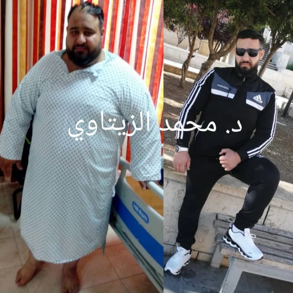 نتيجة تكميم المعدة: نزول 105 كيلو خلال سنة تقريباً دون ترهلات في البطن | د. محمد عبد الوهاب الزيتاوي صورة قبل وبعد عملية تكميم المعدة للمريض محمد من سوريا: من 195 إلى 90 كيلو بعد سنة تقريباً — مركز الدكتور محمد عبد الوهاب الزيتاوي