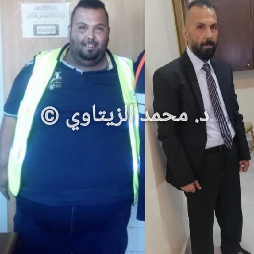 نتيجة تكميم المعدة: من 198 إلى 74 كيلو خلال سنة مع تحسن الضغط والسكري وآلام المفاصل | د. محمد عبد الوهاب الزيتاوي صورة قبل وبعد عملية تكميم المعدة لمحمد جمال النعيرات من الأردن: من 198 إلى 74 كيلو خلال سنة — مركز الدكتور محمد عبد الوهاب الزيتاوي