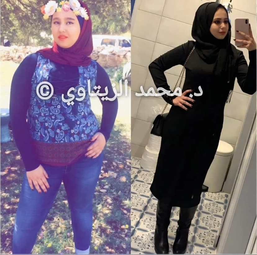 نتيجة تكميم المعدة للبنات: نزول 35 كيلو بعمر 19 سنة خلال أقل من سنة | د. محمد عبد الوهاب الزيتاوي صورة قبل وبعد عملية تكميم المعدة للمريضة مينا العبيدي من العراق: نزول 35 كيلو من وزن 90 كيلو خلال أقل من سنة — مركز الدكتور محمد عبد الوهاب الزيتاوي