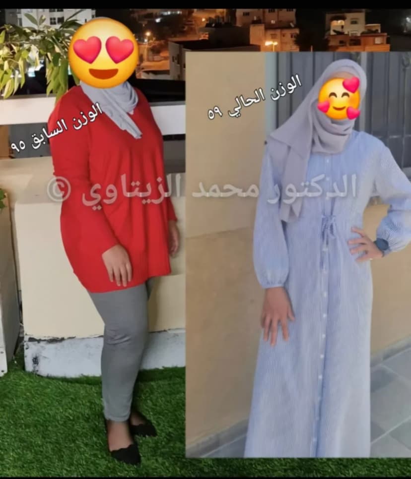 نتيجة تكميم المعدة: نزول 36 كيلو بعد سنتين | د. محمد عبد الوهاب الزيتاوي صورة قبل وبعد عملية تكميم المعدة للمريضة أماني من فلسطين: نزول من 95 إلى 59 كيلو — مركز الدكتور محمد عبد الوهاب الزيتاوي