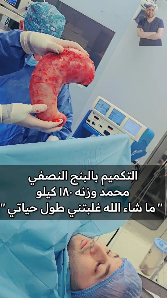 التكميم بالبنج النصفي لوزن 180 كيلو: «ما شاء الله غلبتني طول حياتي» | د. محمد عبد الوهاب الزيتاوي محمد بوزن 180 كيلو مستيقظ على طاولة العمليات بعد تكميم المعدة بالبنج النصفي، والفريق يحمل الجزء المستأصل من المعدة — مركز الدكتور محمد عبد الوهاب الزيتاوي