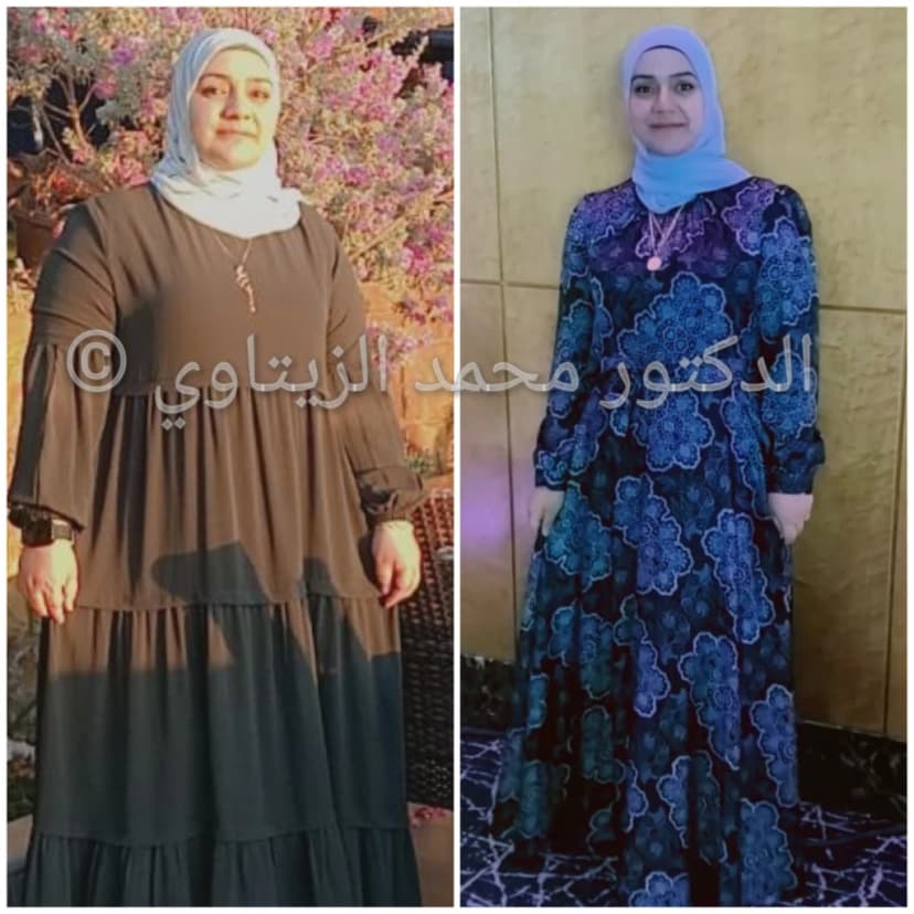 نتيجة تكميم المعدة للسيدات بعد سنة: من 120 إلى 80 كيلو | د. محمد عبد الوهاب الزيتاوي صورة قبل وبعد عملية تكميم المعدة للسيدة رنا الزريقي من الأردن: من 120 إلى 80 كيلو بعد عام من العملية — مركز الدكتور محمد عبد الوهاب الزيتاوي