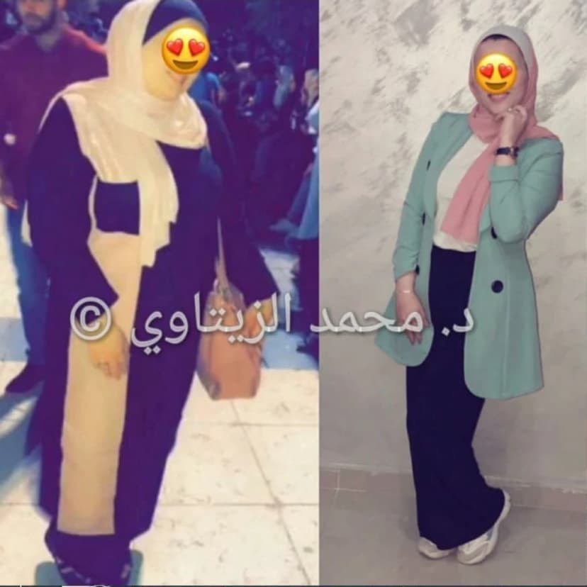 نتيجة تكميم المعدة للسيدات: من 94 إلى 60 كيلو ومن مقاس XL إلى مقاس أصغر | د. محمد عبد الوهاب الزيتاوي صورة قبل وبعد عملية تكميم المعدة للسيدة وئام عنانزة من الأردن: من 94 إلى 60 كيلو خلال أقل من سنة — مركز الدكتور محمد عبد الوهاب الزيتاوي