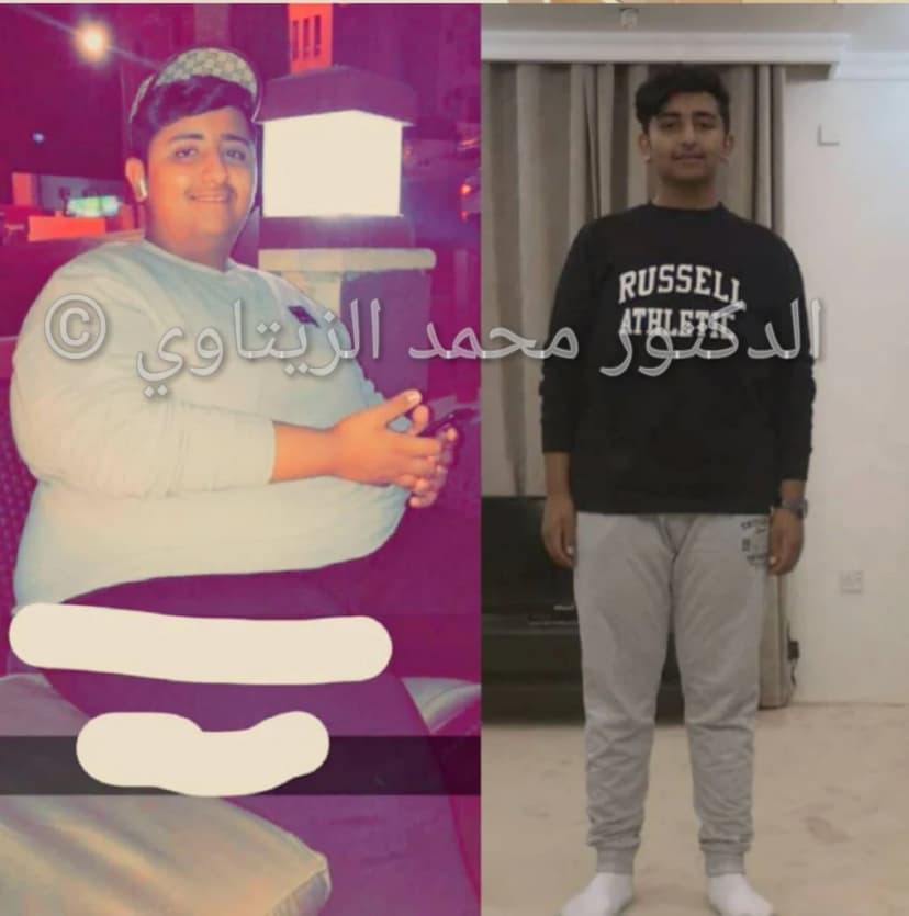 نتيجة تكميم المعدة للمراهقين: نزول 60 كيلو بعمر 15 سنة واختفاء الشخير | د. محمد عبد الوهاب الزيتاوي صورة قبل وبعد عملية تكميم المعدة للمراهق عبدالرحمن من السعودية بعمر 15 سنة: من 135 إلى 75 كيلو — مركز الدكتور محمد عبد الوهاب الزيتاوي