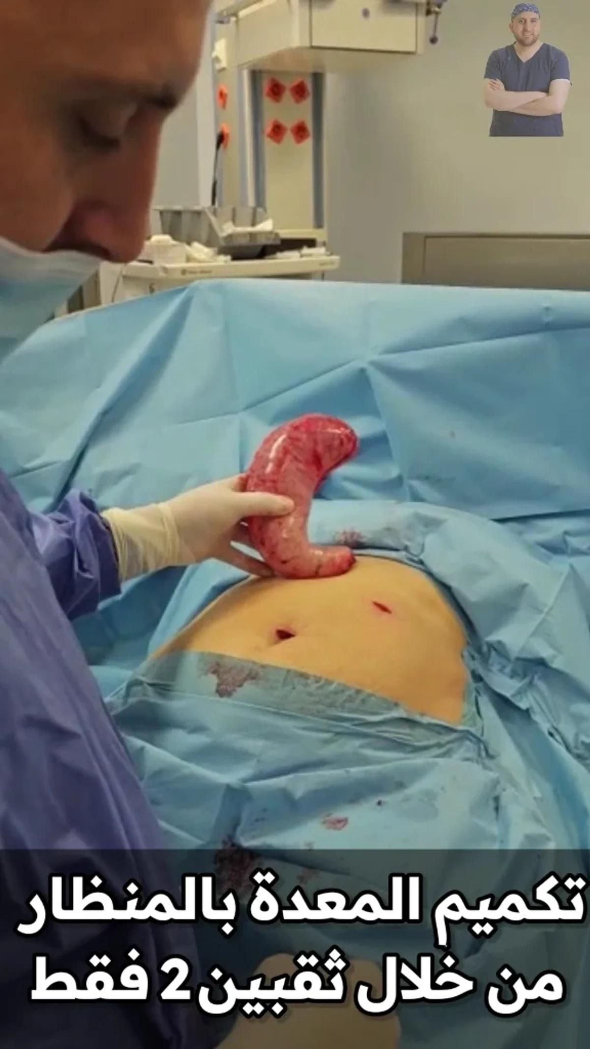 Laparoscopic sleeve gastrectomy through two ports only | Dr. Mohammad Al-Zaitawi Dr. Mohammad Al-Zaitawi holding the removed stomach above an abdomen with only two small ports after laparoscopic sleeve