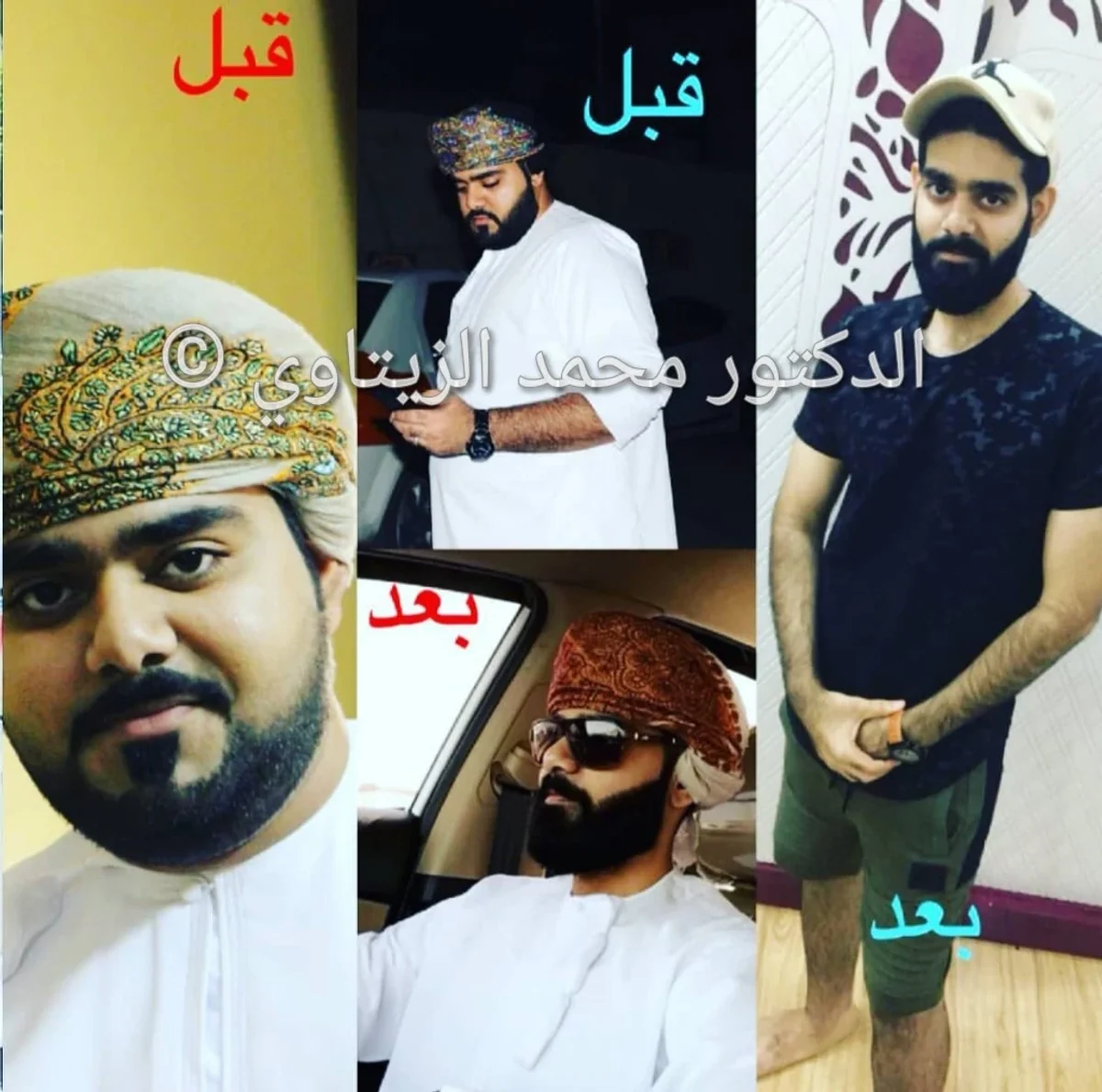 Mini gastric bypass result: 119 kg to 67 kg | Dr. Mohammad Al-Zaitawi Before and after mini gastric bypass: Saeed from Oman went from 119 kg to 67 kg – Dr. Mohammad Al-Zaitawi Center, Jordan