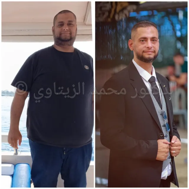 Before and after mini gastric bypass: Kanaan from Palestine went from 140 kg to 81 kg and has kept the weight off 3 years after surgery