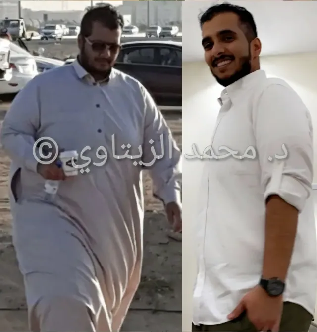 Before and after mini gastric bypass: Ali Al-Shehri from Saudi Arabia went from 189 kg to under 95 kg and kept it off for 4 years