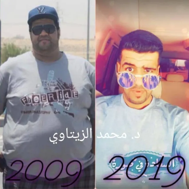 Mini gastric bypass result: 198 kg to 100 kg | Dr. Mohammad Al-Zaitawi Before and after mini gastric bypass: Khalil Jasim from the UAE went from 198 kg to 100 kg
