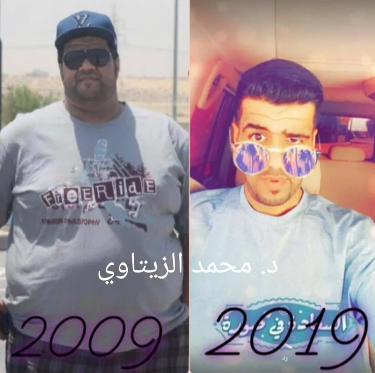 Mini gastric bypass result: 198 kg to 100 kg | Dr. Mohammad Al-Zaitawi Before and after mini gastric bypass: Khalil Jasim from the UAE went from 198 kg to 100 kg