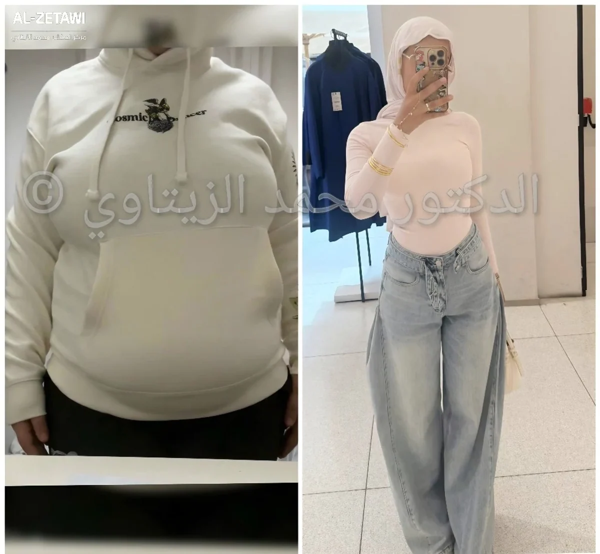 Mini gastric bypass result: 89 kg to 55 kg, XL to XS | Dr. Mohammad Al-Zaitawi Before and after mini gastric bypass: Majd from Palestine went from 89 kg to 55 kg and from size XL to XS