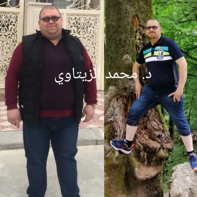 Before and after mini gastric bypass: Ali Al-Mukhtar from Iraq went from 168 kg to 91 kg