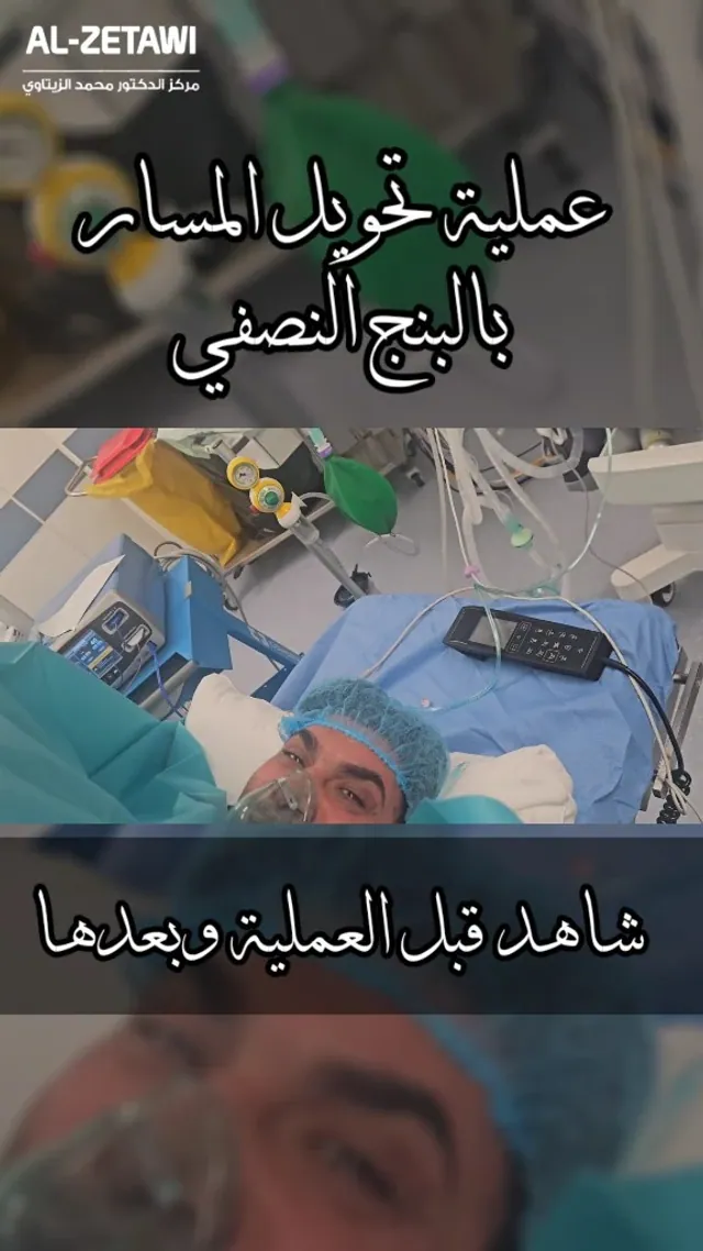 Mini gastric bypass under spinal anesthesia: the patient is awake | Dr. Mohammad Al-Zaitawi Awake patient breathing through an oxygen mask during mini gastric bypass under spinal anesthesia