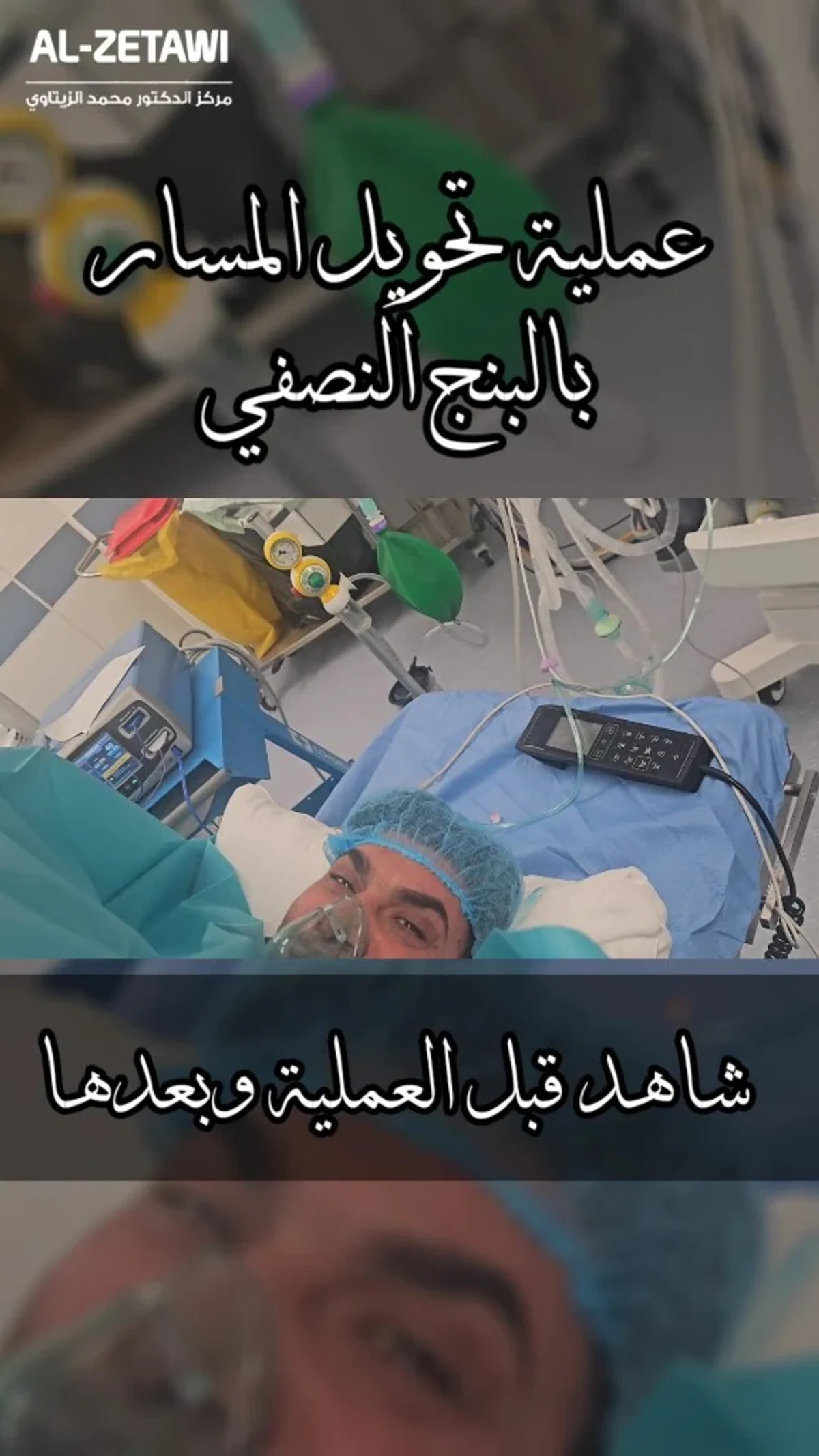 Mini gastric bypass under spinal anesthesia: the patient is awake | Dr. Mohammad Al-Zaitawi Awake patient breathing through an oxygen mask during mini gastric bypass under spinal anesthesia