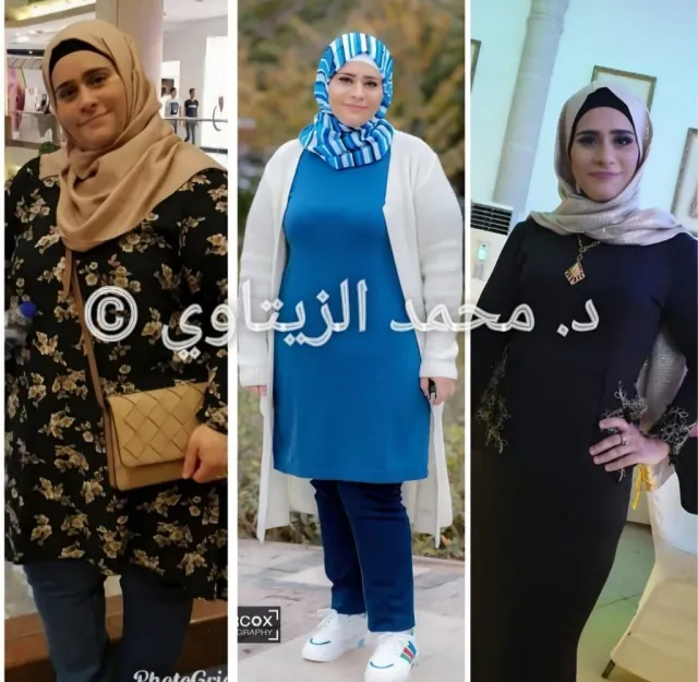 Somaya from Jordan in three stages: weight regain to 150 kg after a sleeve at another hospital, then revision to mini gastric bypass and 62 kg