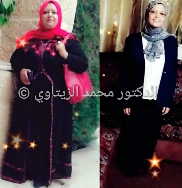 Sleeve gastrectomy result: 102 kg to 54 kg | Dr. Mohammad Al-Zaitawi Before and after sleeve gastrectomy: Wafaa from Jordan went from 102 kg to 54 kg – Dr. Mohammad Al-Zaitawi Center