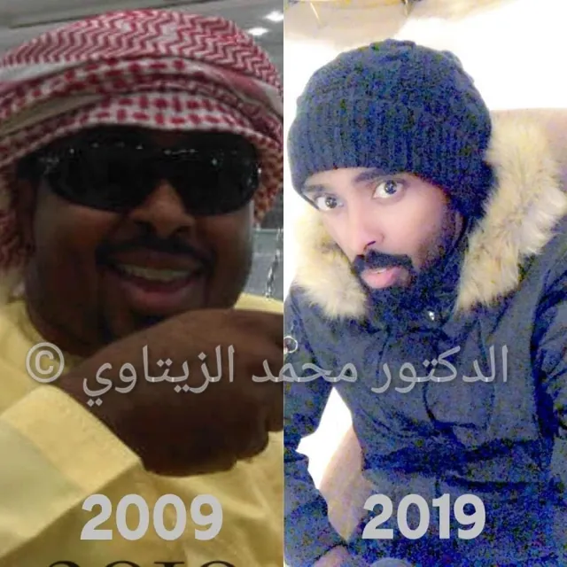 Before and after sleeve gastrectomy: Sultan Al-Ulaili from the UAE went from 102 kg to 61 kg