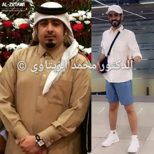 Sleeve gastrectomy result: 120 kg to 68 kg in 18 months | Dr. Mohammad Al-Zaitawi Before and after sleeve gastrectomy: Hussein Al-Kubaisi from Qatar went from 120 kg to 68 kg in a year and a half