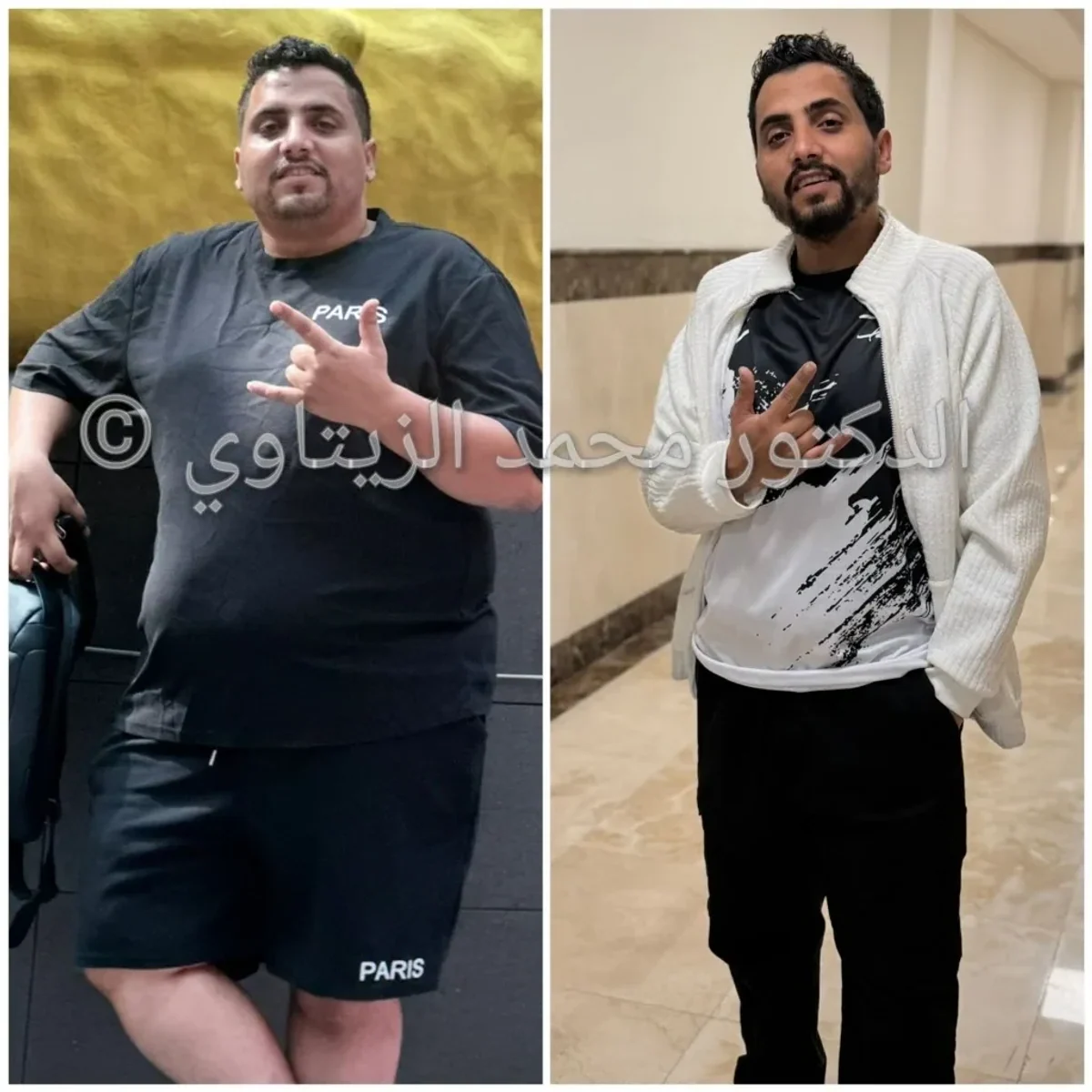 Sleeve gastrectomy in 6 months: 131 kg to 86 kg | Dr. Mohammad Al-Zaitawi Before and after sleeve gastrectomy: Ibrahim Al-Ansi from Yemen went from 131 kg to 86 kg in 6 months