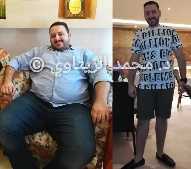 Before and after sleeve gastrectomy: Sultan from Saudi Arabia went from 136 kg to 83 kg