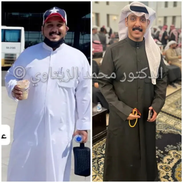 Before and after sleeve gastrectomy: Ahmed Al-Dhafiri from Kuwait went from 140 kg to 83 kg in one year