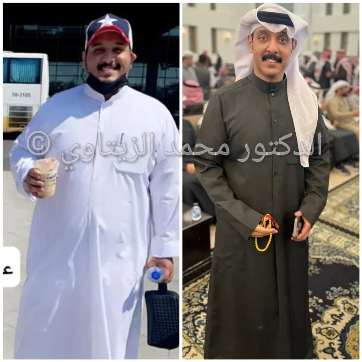 Sleeve gastrectomy: 140 kg to 83 kg in one year | Dr. Mohammad Al-Zaitawi Before and after sleeve gastrectomy: Ahmed Al-Dhafiri from Kuwait went from 140 kg to 83 kg in one year