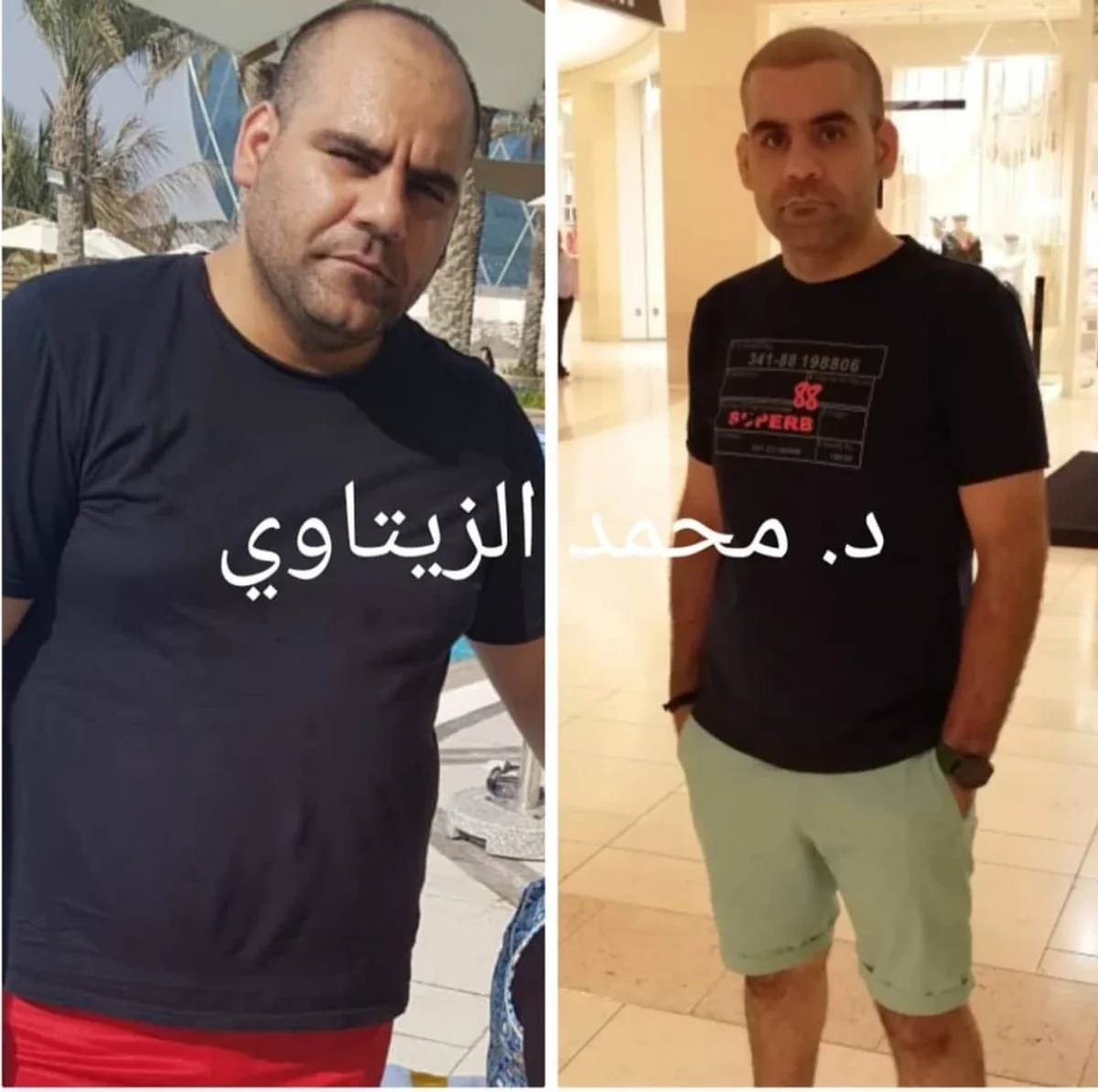Sleeve gastrectomy result: 141 kg to 88 kg | Dr. Mohammad Al-Zaitawi Before and after sleeve gastrectomy: Bassam Al-Homsi from Syria, living in the UAE, went from 141 kg to 88 kg