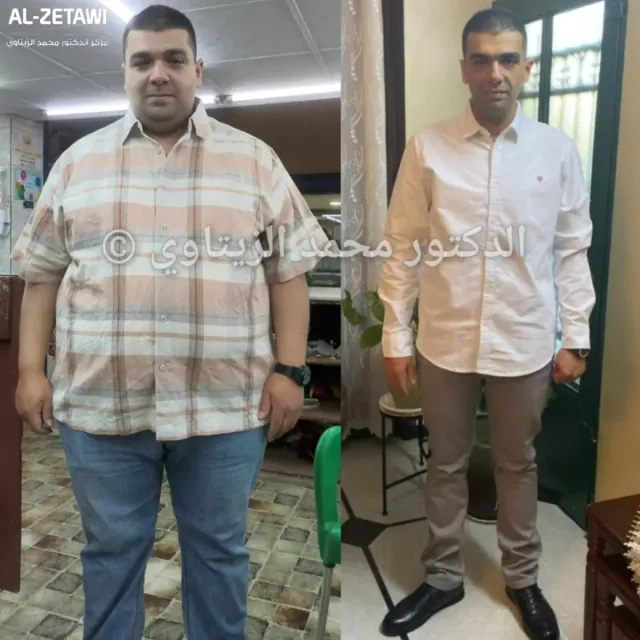 Before and after sleeve gastrectomy: Abdulrahman from Jordan went from 145 kg to 70 kg in about 18 months