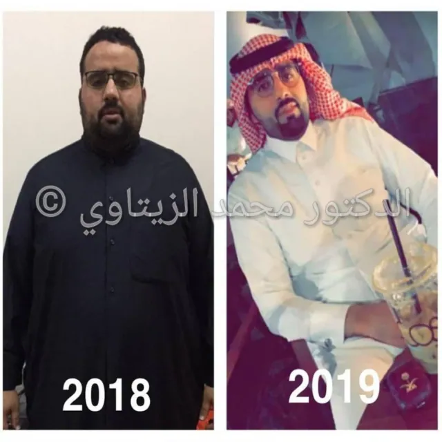 Before and after sleeve gastrectomy: Badr from Khafji, Saudi Arabia, went from 145 kg to 89 kg in 6 months