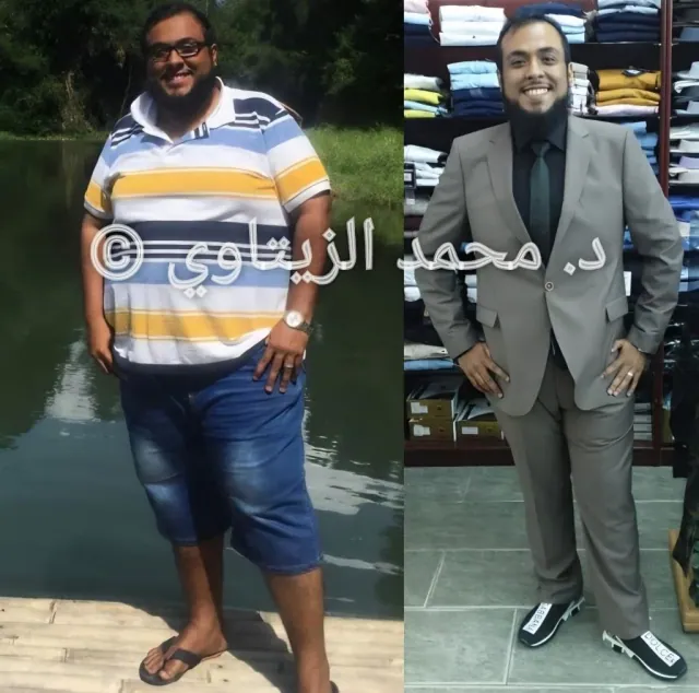 Before and after sleeve gastrectomy: Mohammed Bajandouh from Saudi Arabia went from 150 kg to 87 kg in one year