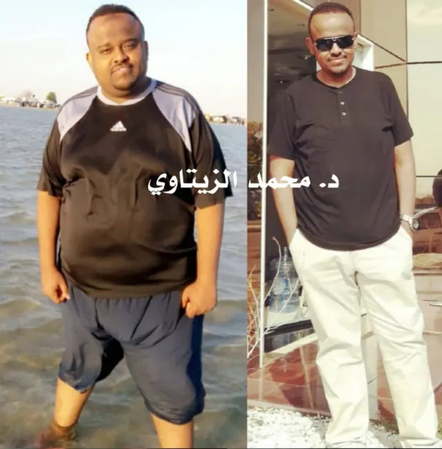Before and after sleeve gastrectomy: Mohammed from Yemen, living in Saudi Arabia, went from 151 kg to 98 kg