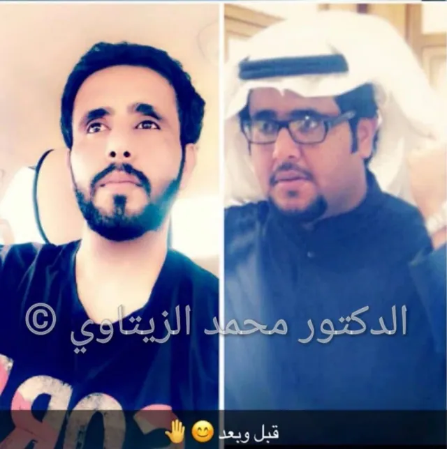 Sleeve gastrectomy result: 174 kg to 101 kg | Dr. Mohammad Al-Zaitawi Before and after sleeve gastrectomy: Hussein Al-Yami from Saudi Arabia went from 174 kg to 101 kg