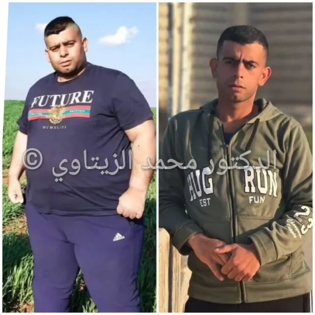 Before and after sleeve gastrectomy: Mahmoud Mayyas from Jordan went from 180 kg to 89 kg in 10 months