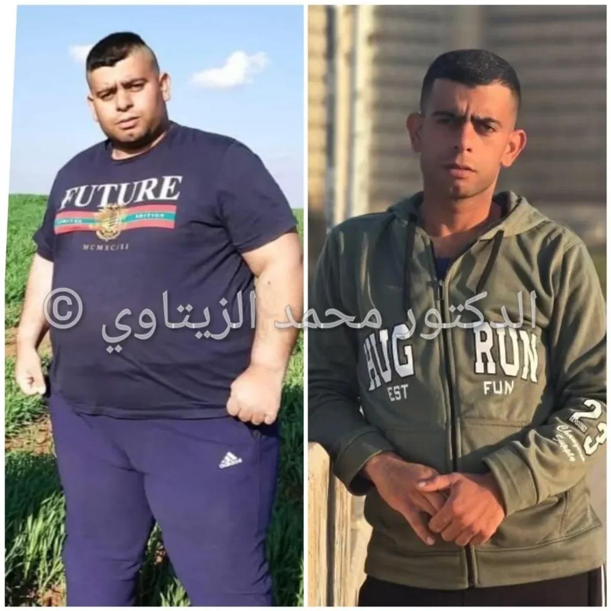 Sleeve gastrectomy: 180 kg to 89 kg in 10 months | Dr. Mohammad Al-Zaitawi Before and after sleeve gastrectomy: Mahmoud Mayyas from Jordan went from 180 kg to 89 kg in 10 months