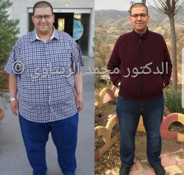 Before and after sleeve gastrectomy: Hassan Rafea Al-Mukhtar from Iraq went from 187.5 kg to 93 kg