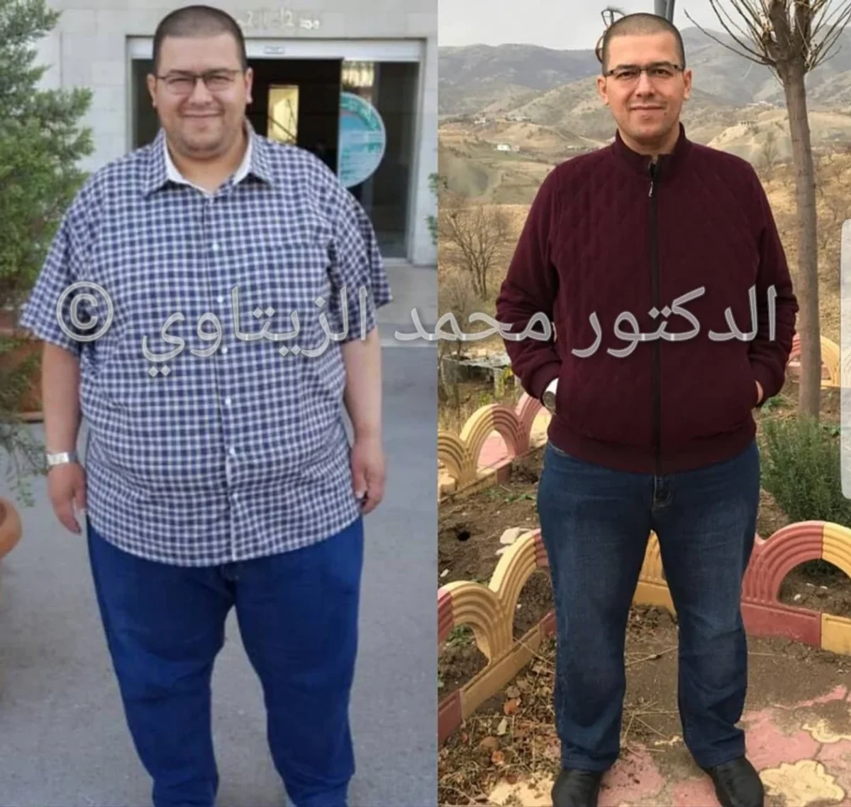 Sleeve gastrectomy result: 187.5 kg to 93 kg | Dr. Mohammad Al-Zaitawi Before and after sleeve gastrectomy: Hassan Rafea Al-Mukhtar from Iraq went from 187.5 kg to 93 kg