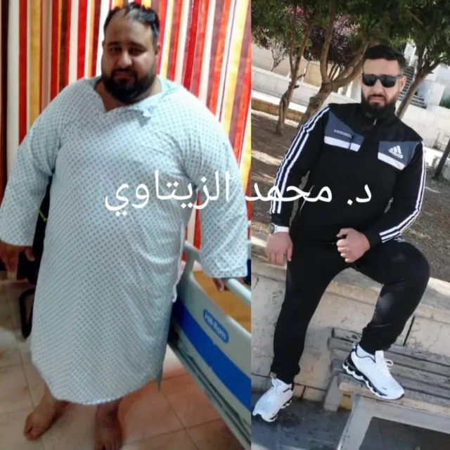 Before and after sleeve gastrectomy: Mohammed from Syria went from 195 kg to 90 kg – Dr. Mohammad Al-Zaitawi Center, Jordan