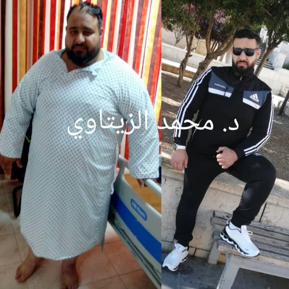 Sleeve gastrectomy result: 195 kg to 90 kg | Dr. Mohammad Al-Zaitawi Before and after sleeve gastrectomy: Mohammed from Syria went from 195 kg to 90 kg – Dr. Mohammad Al-Zaitawi Center, Jordan