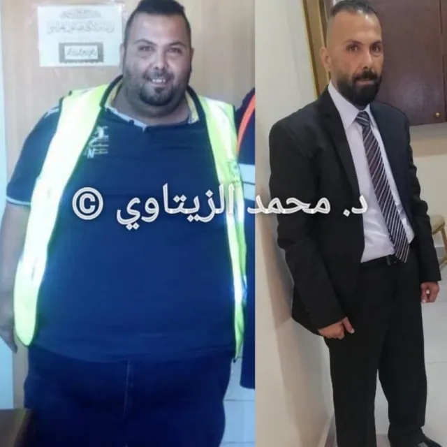 Sleeve gastrectomy: 198 kg to 74 kg in one year | Dr. Mohammad Al-Zaitawi Before and after sleeve gastrectomy: Mohammad Jamal Al-Nuairat from Jordan went from 198 kg to 74 kg in one year