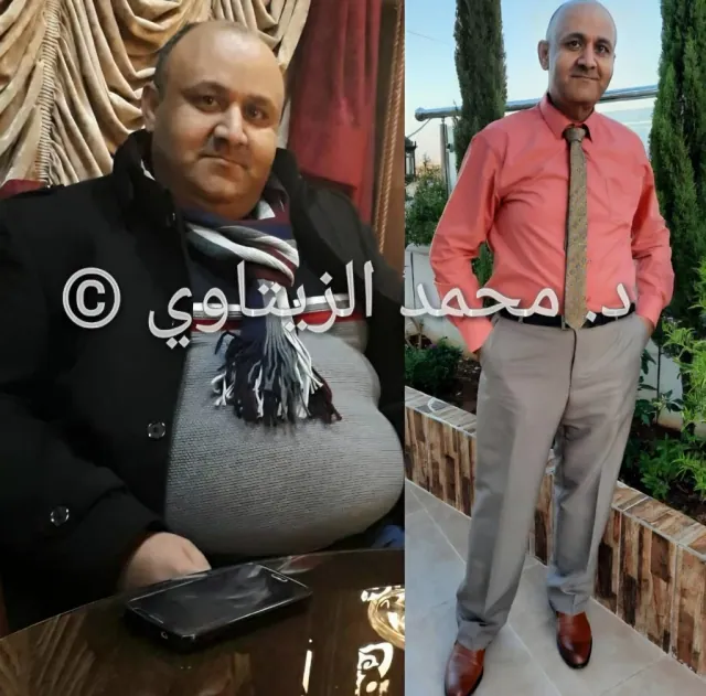 Before and after sleeve gastrectomy: Khaldoun Masa'deh from Jordan went from 147 kg to 84 kg and kept it off for 2 years