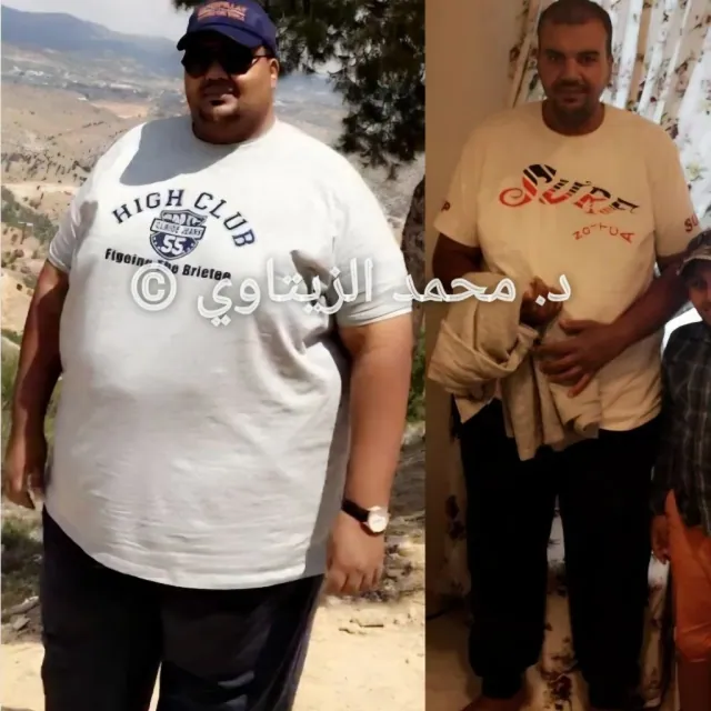 Sleeve gastrectomy result: 223 kg to 113 kg | Dr. Mohammad Al-Zaitawi Before and after sleeve gastrectomy: Abdulrahman Bajunaid from Sudan went from 223 kg to 113 kg