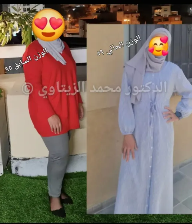 Before and after sleeve gastrectomy: Amani from Palestine went from 95 kg to 59 kg – Dr. Mohammad Al-Zaitawi Center