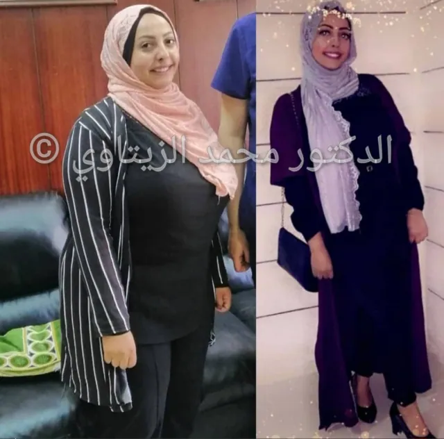 Before and after sleeve gastrectomy following a gastric balloon: Rand from Jordan went from 102 kg to 78 kg