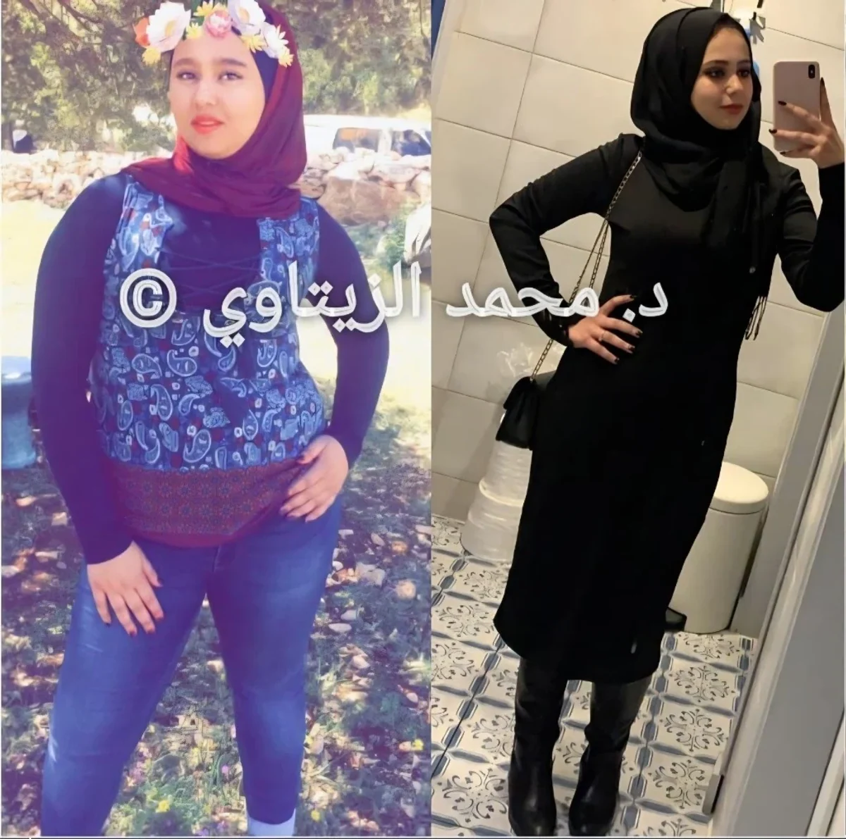 Sleeve gastrectomy result: 35 kg lost from 90 kg | Dr. Mohammad Al-Zaitawi Before and after sleeve gastrectomy: Mina Al-Obaidi from Iraq lost 35 kg from 90 kg – Dr. Mohammad Al-Zaitawi Center, Jordan
