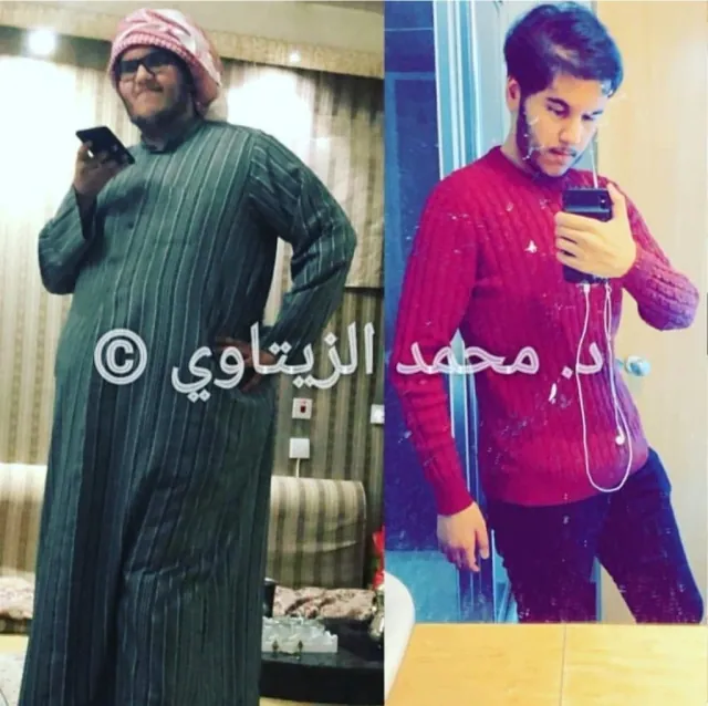 Sleeve gastrectomy result: 162 kg to 85 kg | Dr. Mohammad Al-Zaitawi Before and after sleeve gastrectomy: Mohammed from Qatar went from 162 kg to 85 kg – Dr. Mohammad Al-Zaitawi Center, Jordan