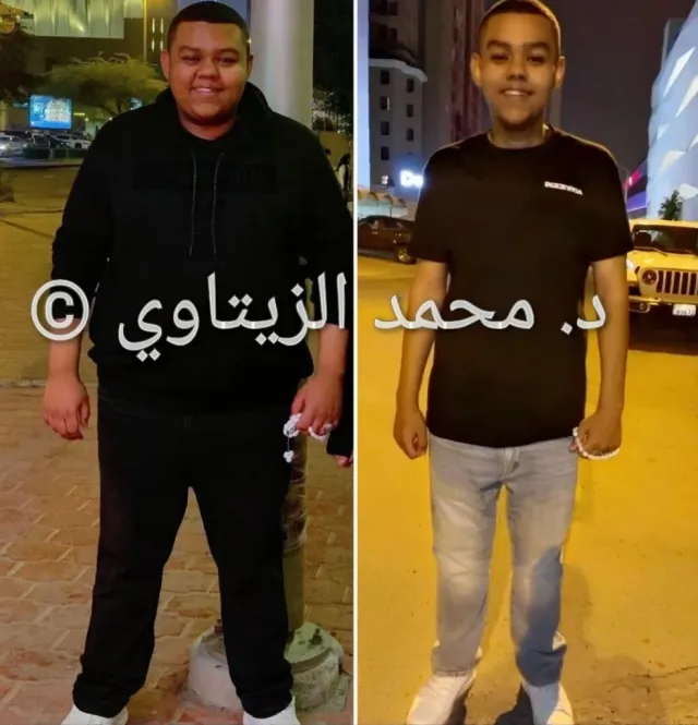 Sleeve gastrectomy result: 143.5 kg to 82 kg | Dr. Mohammad Al-Zaitawi Before and after sleeve gastrectomy: Naif from Kuwait went from 143.5 kg to 82 kg – Dr. Mohammad Al-Zaitawi Center, Jordan