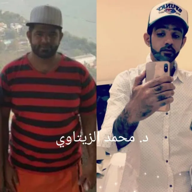 Before and after sleeve gastrectomy: Ahmed Al-Balushi from Oman went from 115 kg to 62 kg